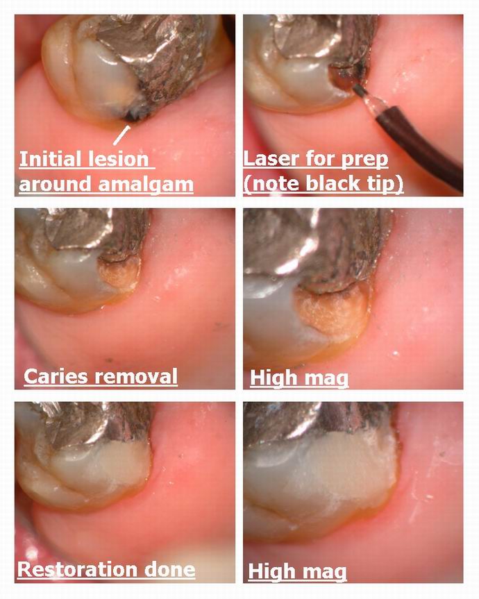 Resize of Class V around amalgam.jpg